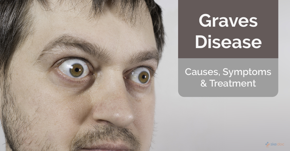 Graves Disease: Causes, Symptoms and Treatment
