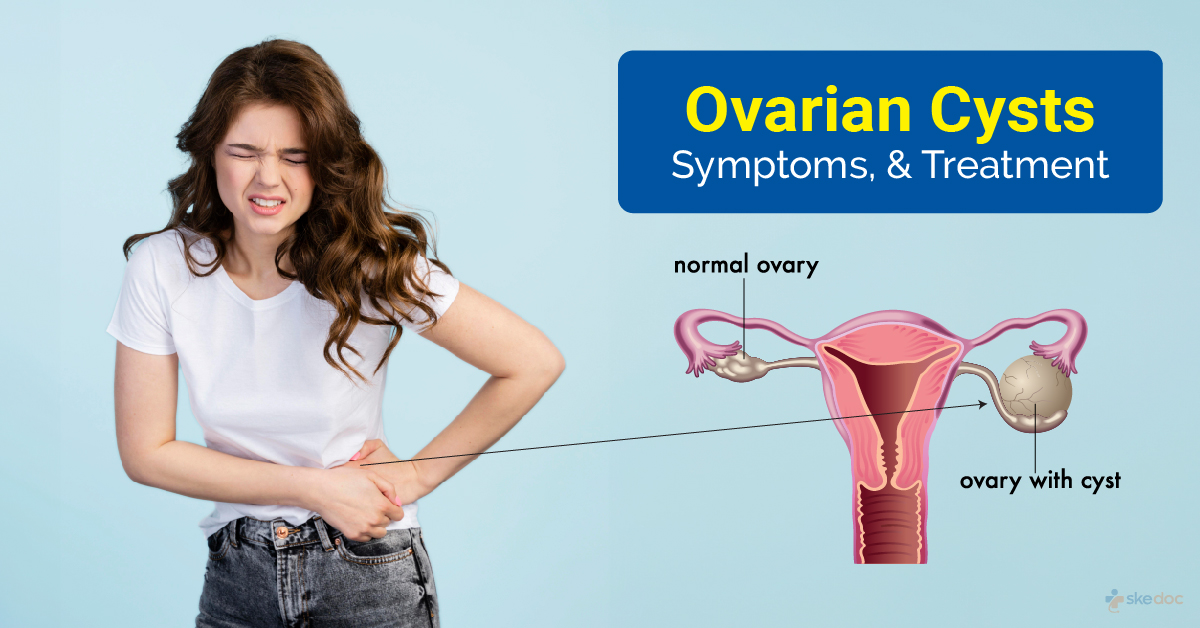 Ovarian Cyst
