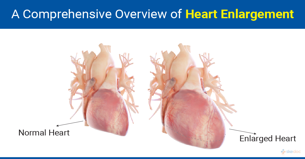 Heart Enlargement