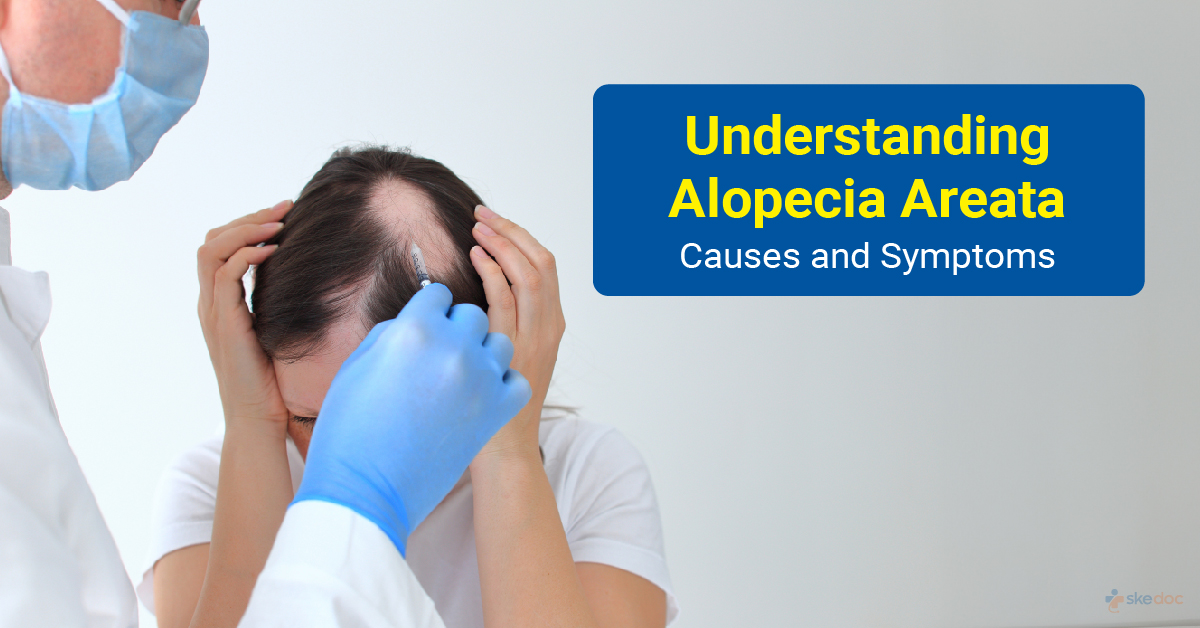 Alopecia Areata - Causes and Treatment
