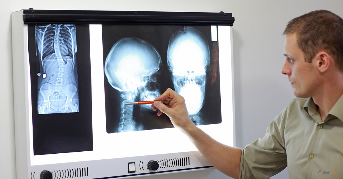 Skull Fracture: Types, Causes, and Symptoms