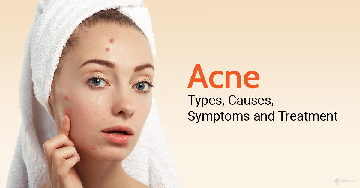 Acne: Causes, Symptoms, Prevention and Treatment