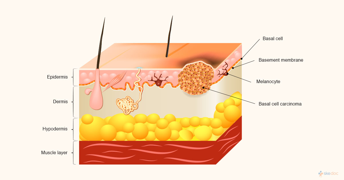Basal Cell Cancer of the skin