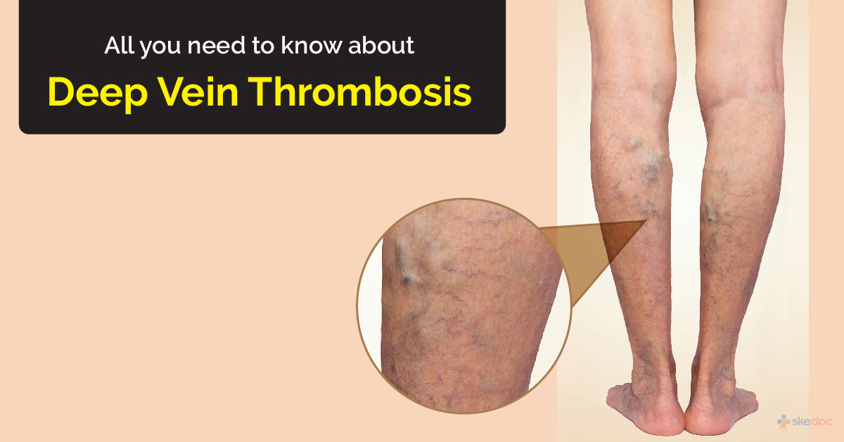 Deep Vein Thrombosis (DVT) - Cause, Symptoms, Treatment