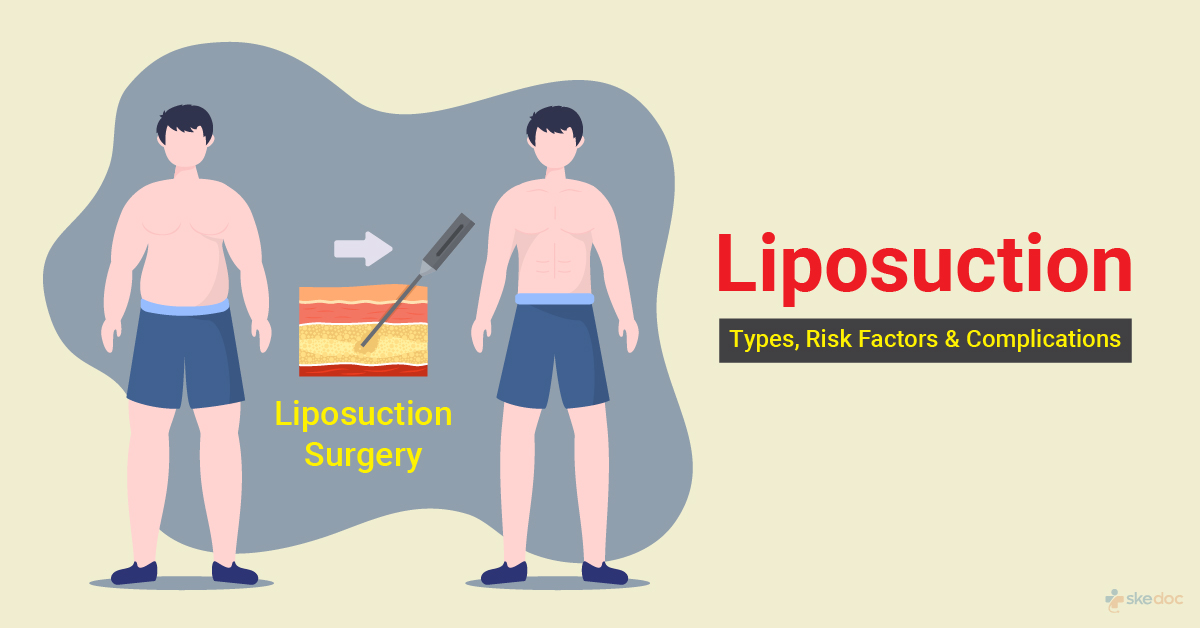 Liposuction  - Types, Risk Factors and Complications