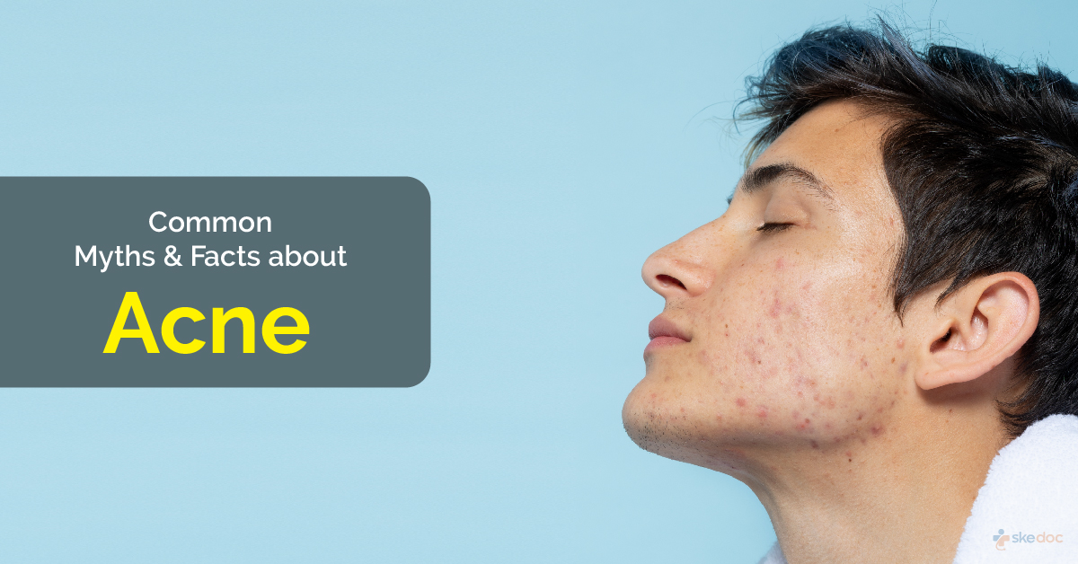 Common Myths & Facts about Acne