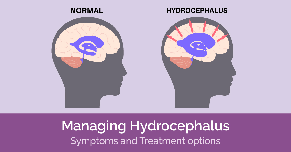 Managing Hydrocephalus-Symptoms and Treatment Options