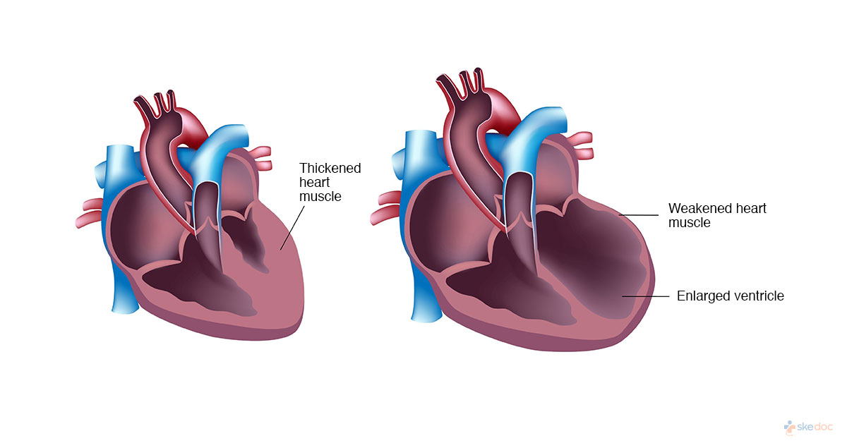 Heart Enlargement