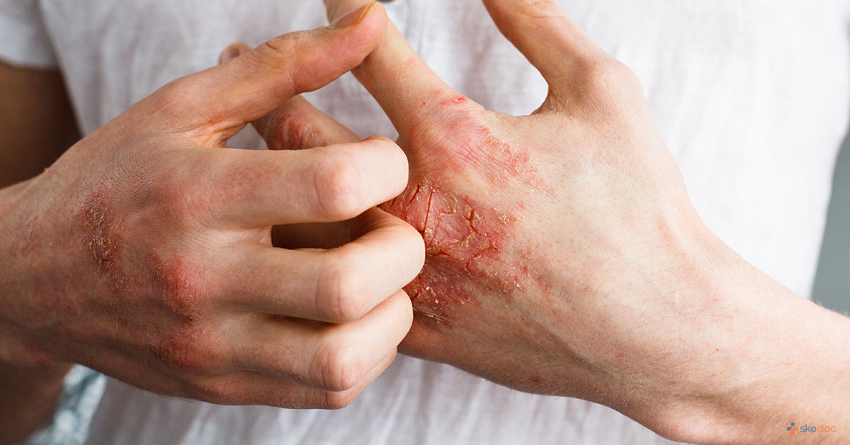 Eczema and What You Need to Know About It 