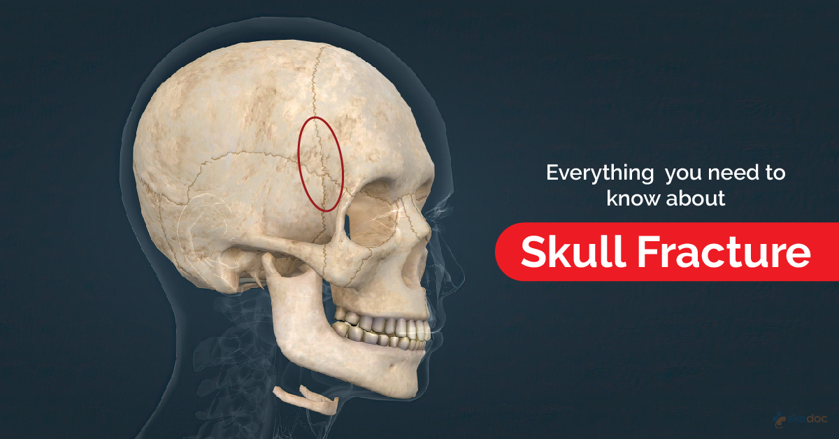 Skull Fracture Types Causes And Symptoms Skedoc