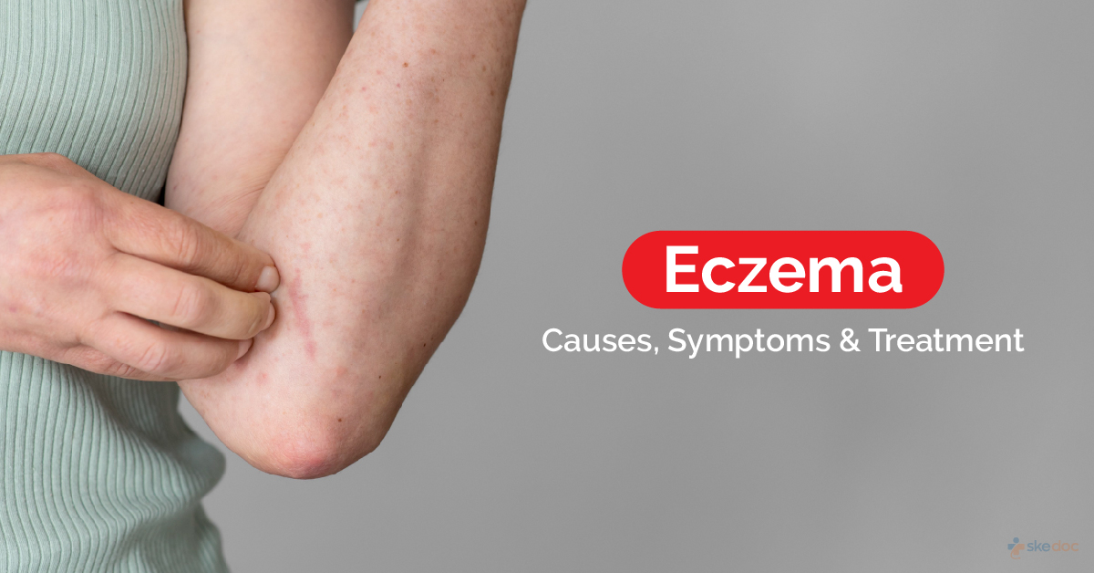 Eczema - Causes, Symptoms & Treatment