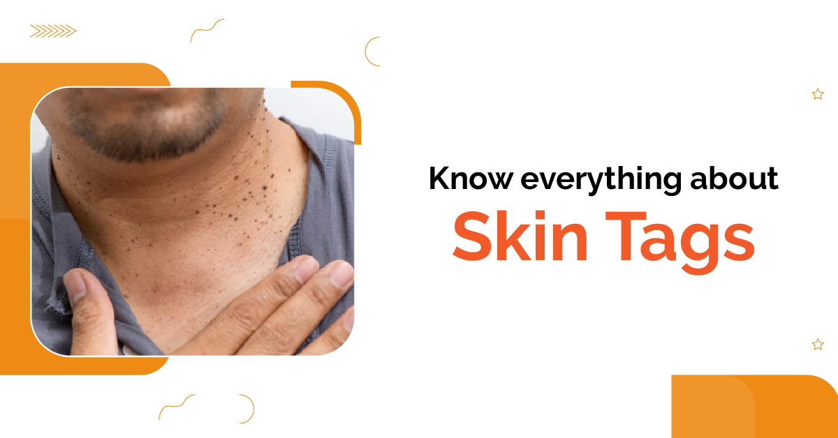 All You Need to Know About Skin Tags