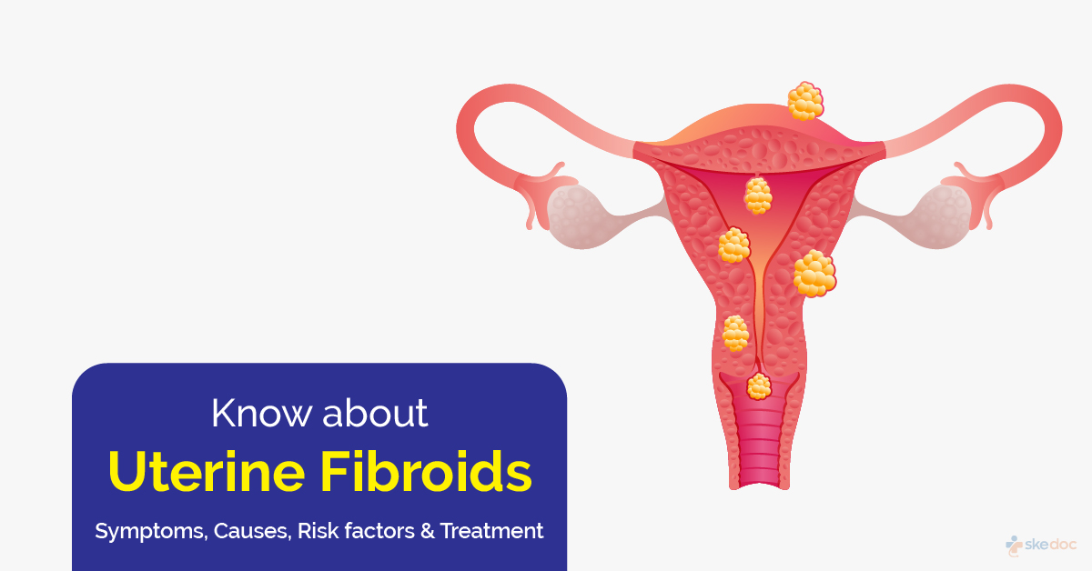Uterine Fibroids: Symptoms, Causes and Treatment
