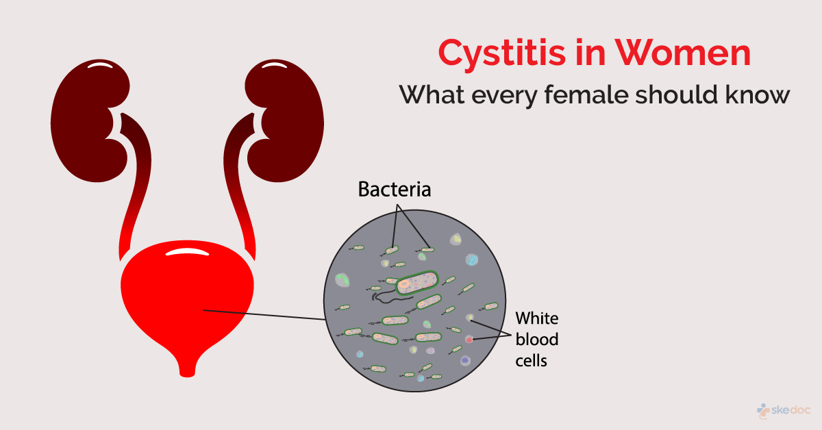 Bladder infection (cystitis) Guide: Causes, Symptoms and Treatment