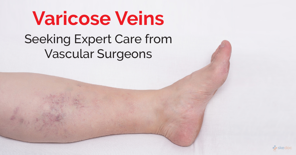 Varicose Veins:Seeking Expert Care from Vascular Surgeons