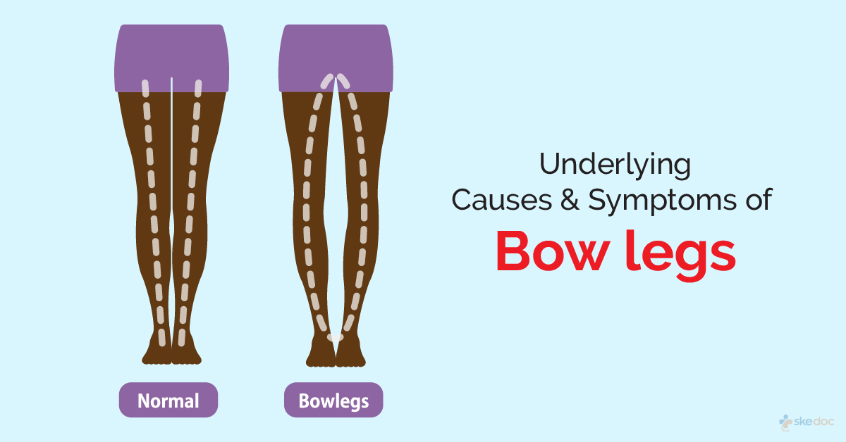 Bow Legged (Genu Varum): What Is It, Causes & Treatment