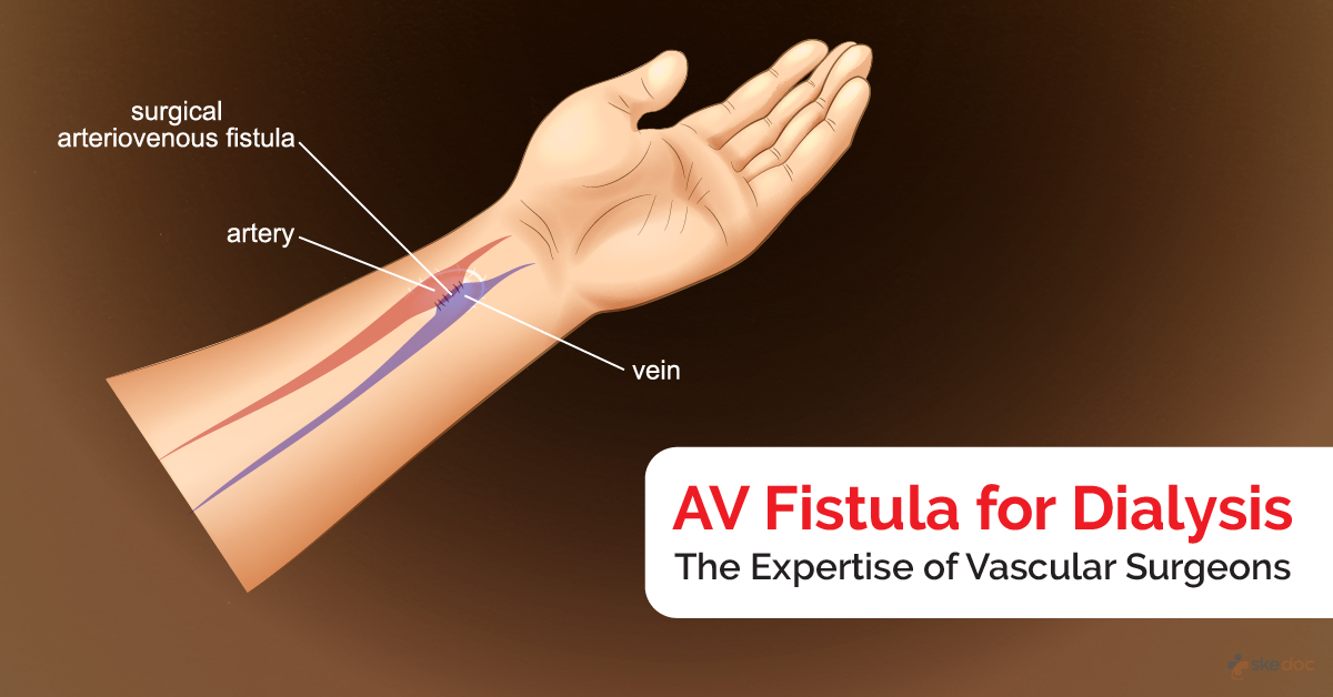 AV Fistula for Dialysis:The Expertise of Vascular Surgeons