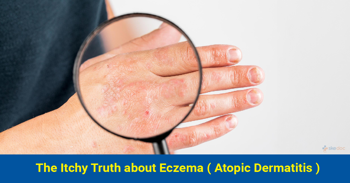 Should You Consult a Dermatologist for Eczema 