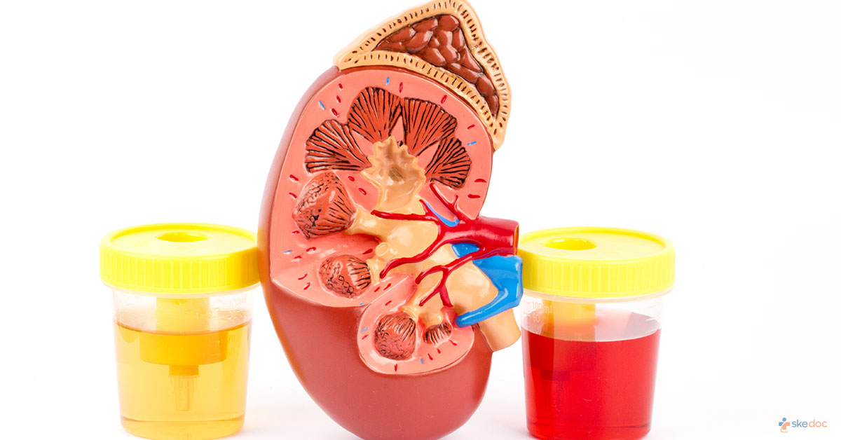 Hematuria Symptoms Treatment Causes Types And Diagnosis 