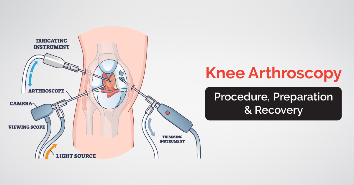 Knee Arthroscopy - Procedure, Preparation and Recovery
