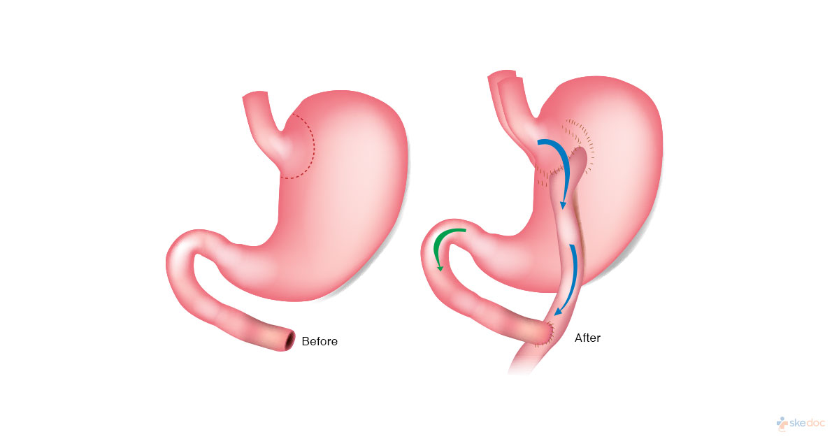 Gastric Banding Lap Band Surgery Types Indications Procedure And Complications