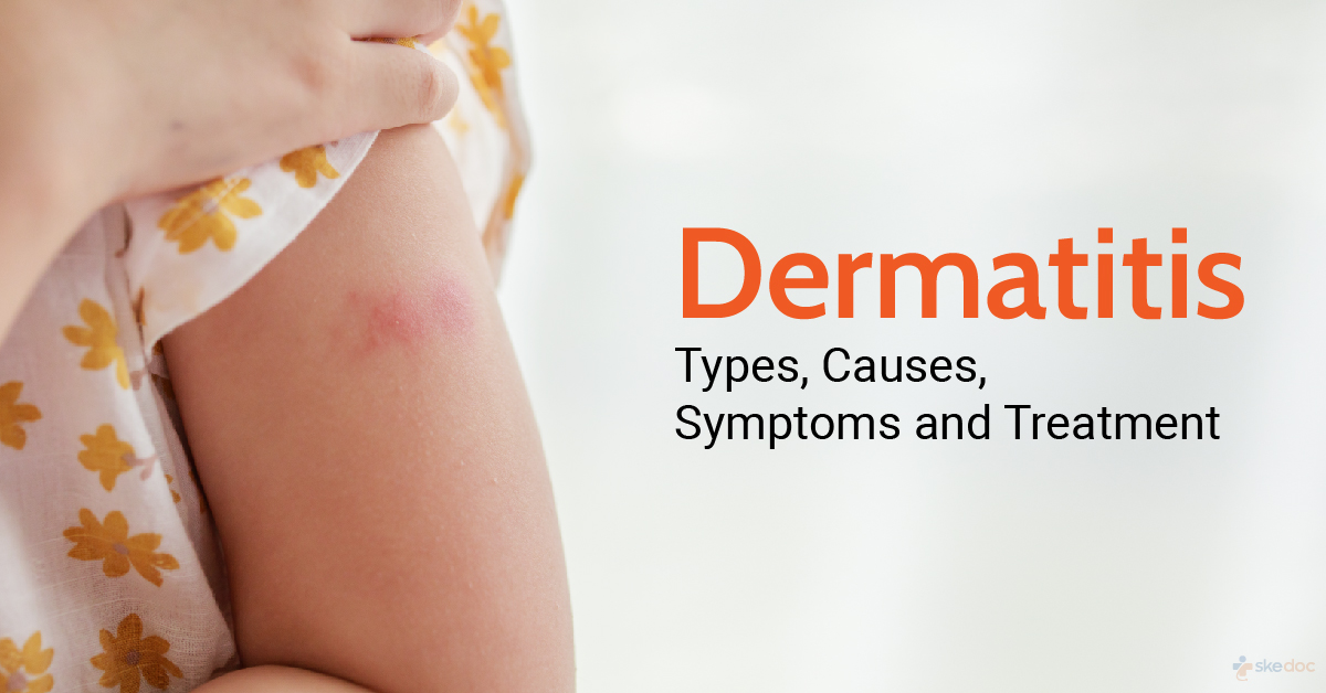 All you need to know about Dermatitis